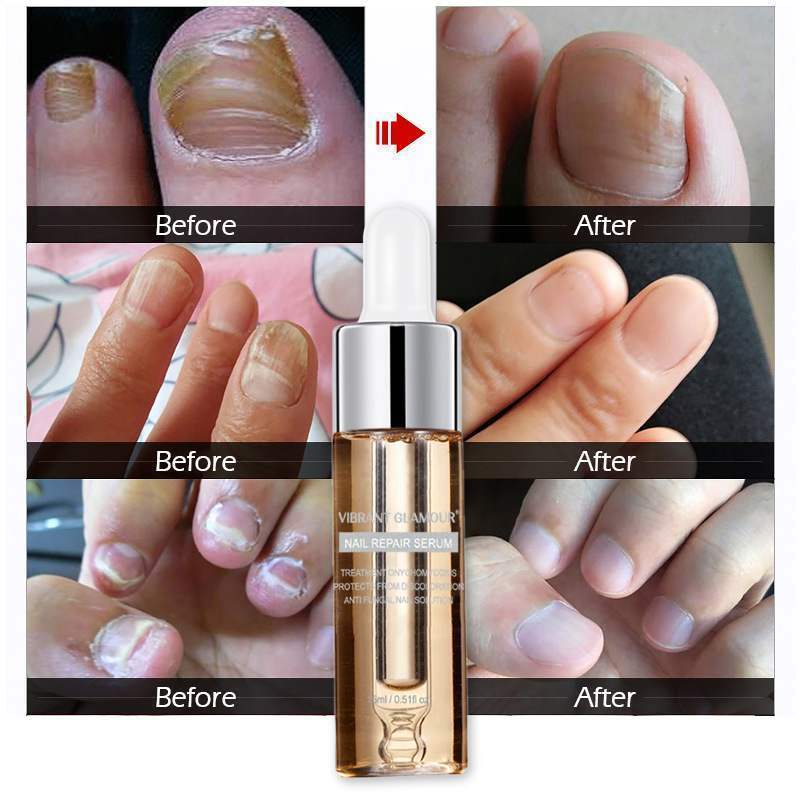 NAIL FUNGUS Care - NAIL REPAIR FLUID - Hand & Foot - Bright Nail