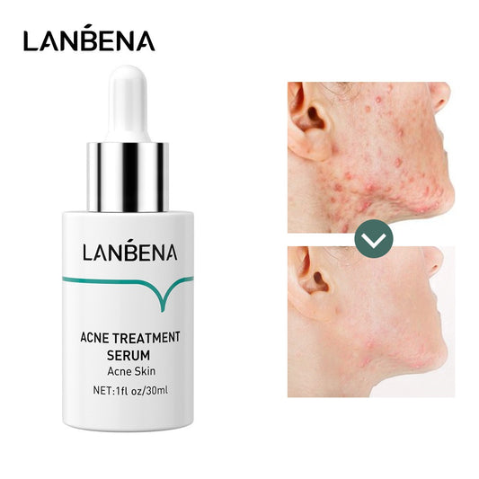 ACNE TREATMENT SERUM - LANBENA